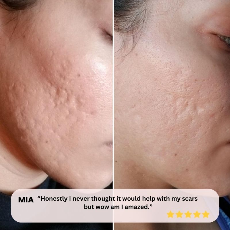 FDA Approved LED Light Therapy Machine
