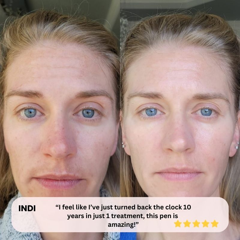 Dr. Pen Ultima M8 Microneedling Pen