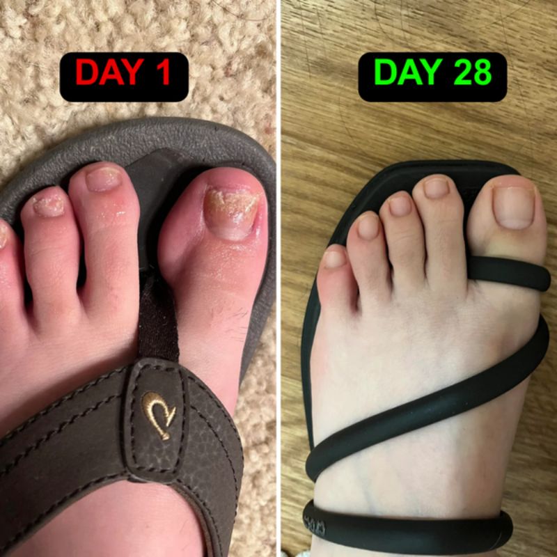 Laser Treatment Device for Nail Fungus and Onychomycosis