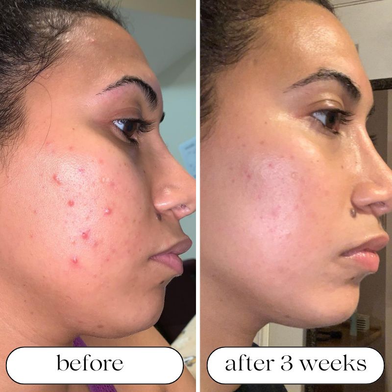 FDA Approved LED Light Therapy Machine
