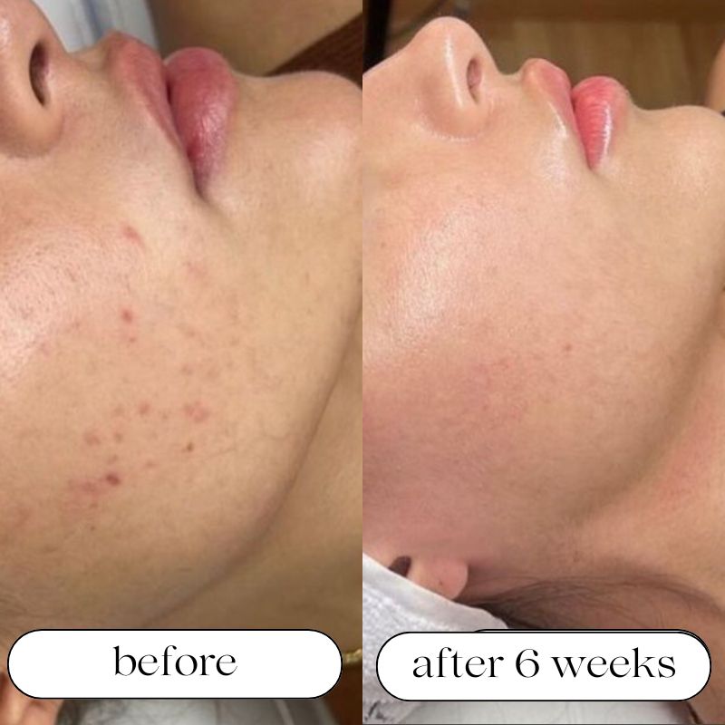 LED Light Therapy Mask